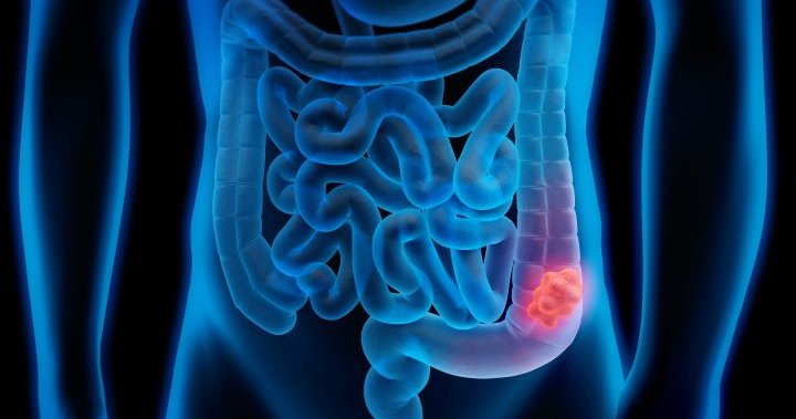 Colorectal cancer cases rising among younger adults in Canada and U.S. – National
