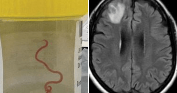 Doctors pull 8-centimetre-long live worm from patient’s brain during surgery – National