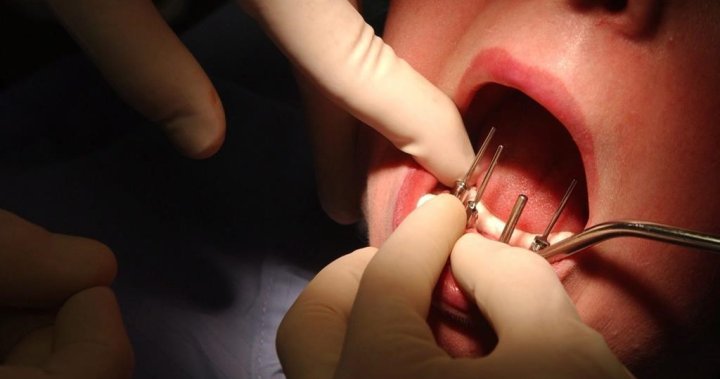Dentist sued for performing 4 root canals, 8 crowns, 20 fillings in one day – National