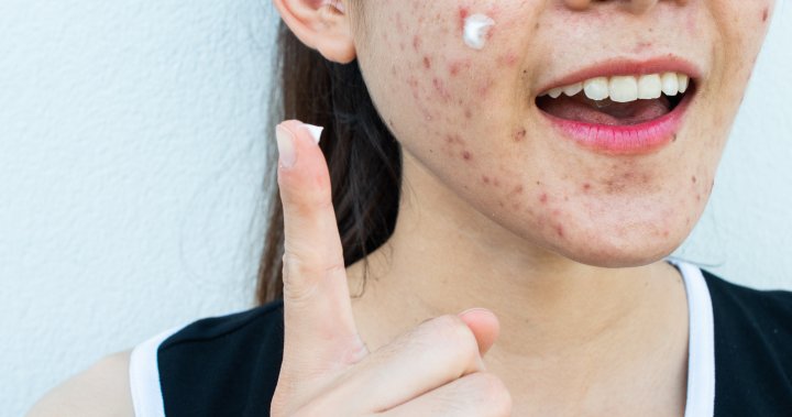 Cancer-causing chemical benzene found in popular acne products: U.S. lab – National