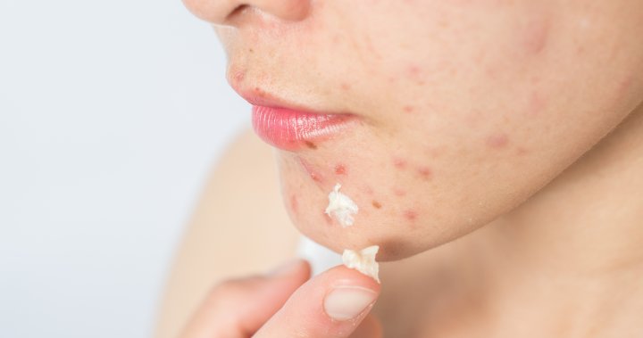 Health Canada ‘reviewing’ U.S. lab’s findings of benzene in acne products – National