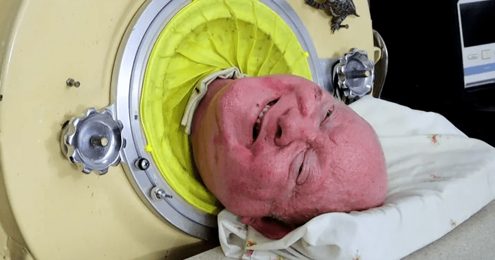 Paul Alexander, who lived in iron lung for more than 70 years, dies at 78 – National